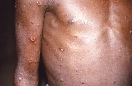 This 1997 image provided by U.S. Centers for Disease Control and Prevention shows the right arm and torso of a patient, whose skin displayed a number of lesions due to what had been an active case of monkeypox. As health authorities in Europe and elsewhere roll out vaccines and drugs to stamp out the biggest monkeypox outbreak beyond Africa, in 2022, some doctors are acknowledging an ugly reality: The resources to slow the disease's spread have long been available, just not to the Africans who h