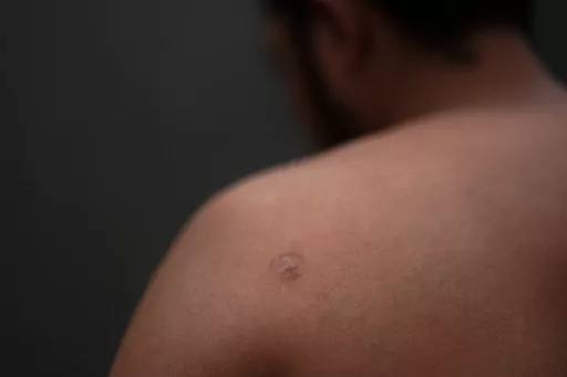 Asylum seeker Teodoso Vargas shows bullet wounds to his torso, after being shot nine times during a robbery in his native Honduras, Monday, May 22, 2023, as he waits to apply for asylum in the border city of Tijuana, Mexico. Asylum-seekers say joy over the end of the public health restriction known as Title 42 this month is turning into anguish with the realization of how the Biden administration's new rules affect them. Though the government opened some new avenues for immigration, many people'