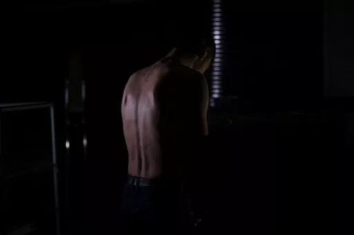 In this Nov. 23, 2022 photo, Igor shows the remains of marks on his back after allegedly being tortured by Russian forces in Kherson. The 22-year-old, accused of providing Ukrainians with Russia's military positions, was stung with a taser along his back for two and half hours and then forced to stay awake, seated in a chair all night. He was freed after two days but not before writing a letter providing details about a relative of his uncle's who the Russians wanted information on. (AP Photo/Be